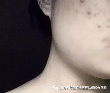 痘痘不挤会有黑色的印