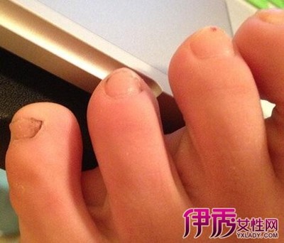 大脚指甲变黑是怎么回事