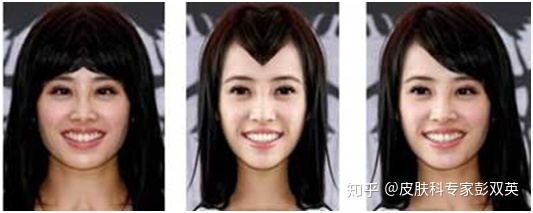 脸型不正左右脸不对称