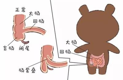 宝宝肠套叠症状