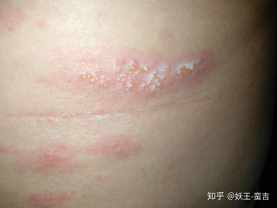 疱疹图片初期怎么治疗
