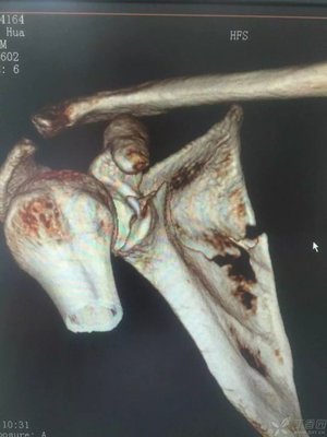 肩胛骨骨折怎么治疗