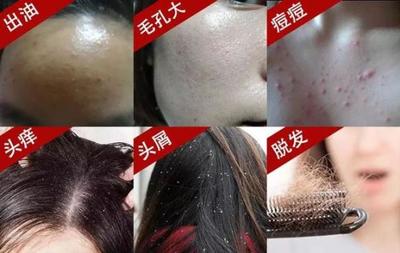 头皮长痘痘有点脱发