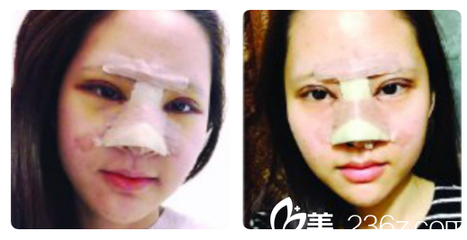 深圳美莱双眼皮怎么样