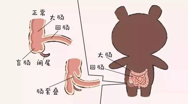 宝宝肠套叠怎么办