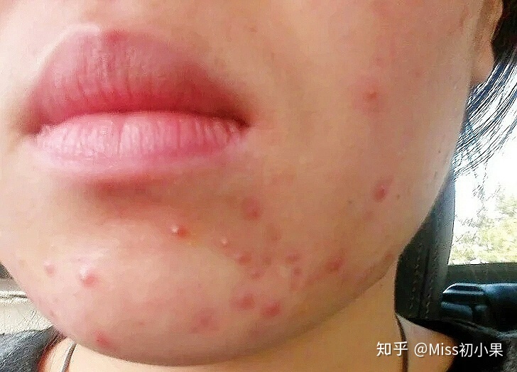 如何把痘痘皮肤养好