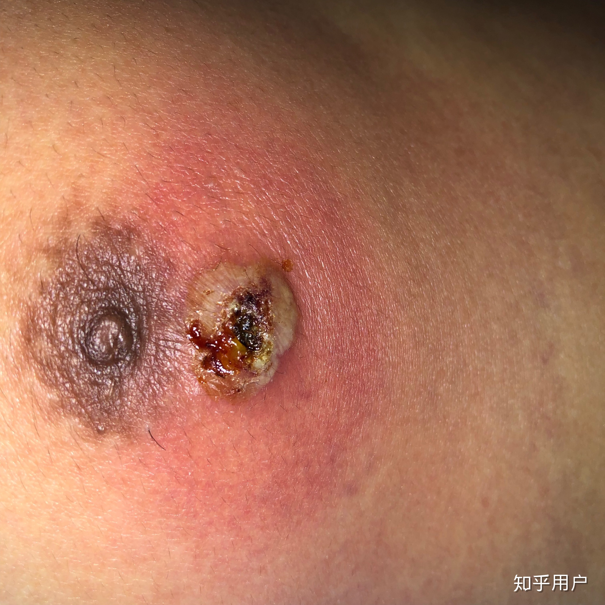 怎样快速催熟痘痘红霉素