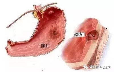 胃溃疡伴出血怎么治疗