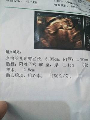 12周胎儿nt值正常范围
