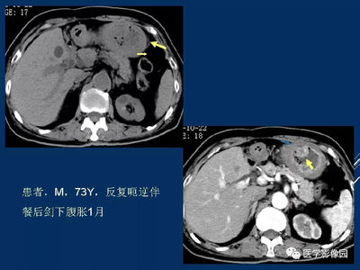 间质瘤是怎么回事