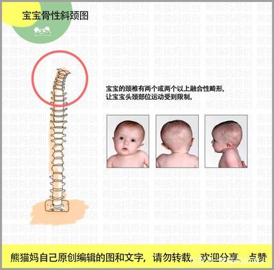 新生儿 斜颈