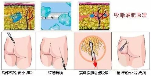 抽脂融脂