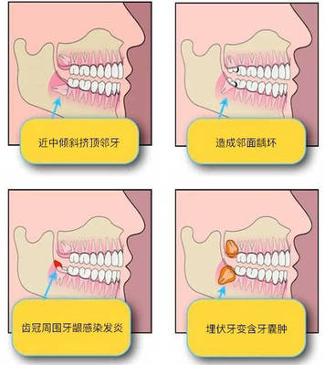 智齿拔牙疼吗