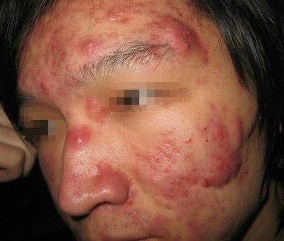 痘痘脓水挤不完