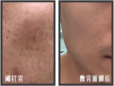 水光针后注意事项