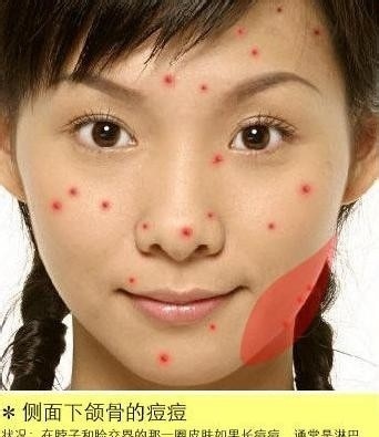 脸上的痘痘是什么原因分析