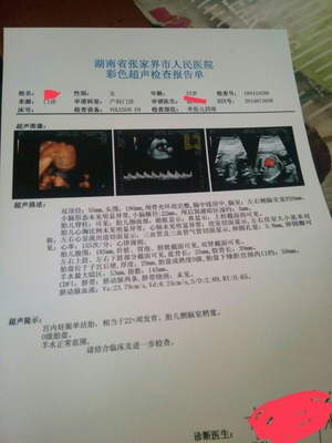 侧脑室宽说明胎儿聪明