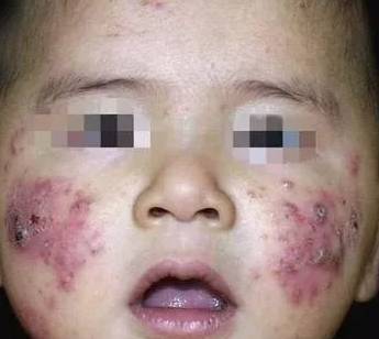 痘痘留下疤痕怎么办