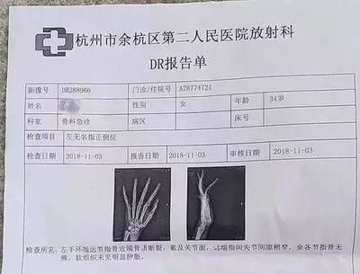 打架手指骨折赔偿标准