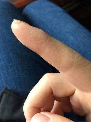 手指头褪皮是怎么回事