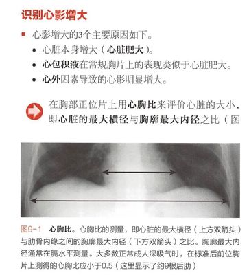 心脏影增大是怎么回事