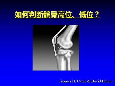 髌骨疼痛怎么治疗