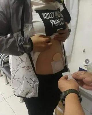 口腔带状疱疹怎么治疗