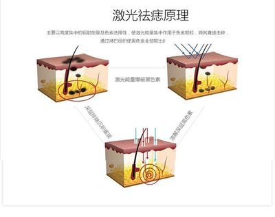 激光祛痣原理