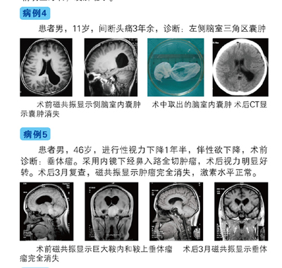 经鼻蝶微创垂体囊肿手术费用多少钱