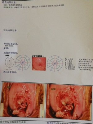 宫颈息肉会影响胎儿吗
