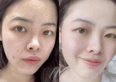 脸上有小的肤色痘痘