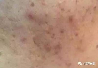 痘痘一直有脓包怎么办