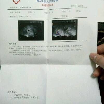 卵巢包块是怎么回事