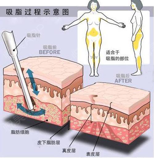环形抽脂