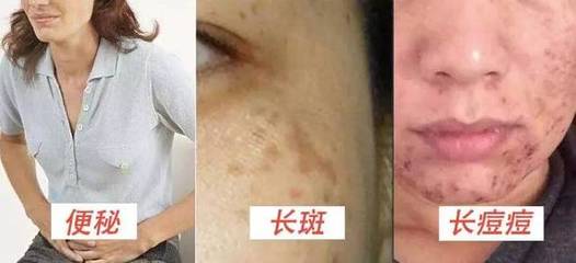 脸色起痘痘怎么排毒