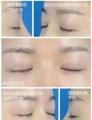 割完双眼皮恢复期