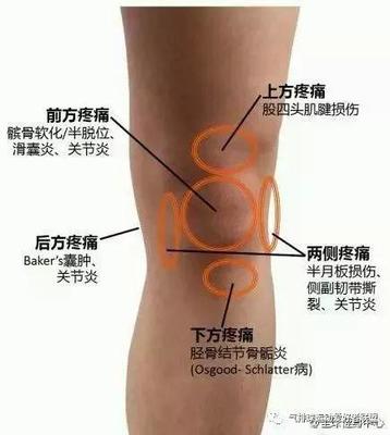 膝关节滑囊炎怎么治疗