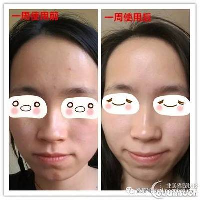 额头鼻头上长痘痘