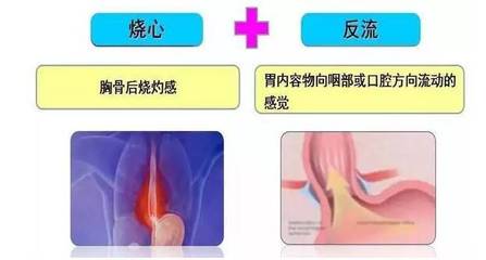 半夜胃反酸想吐是怎么回事