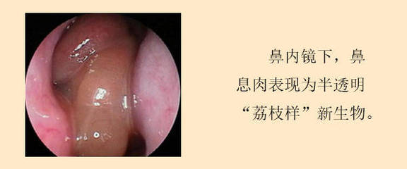 宝宝鼻息肉是什么原因引起的