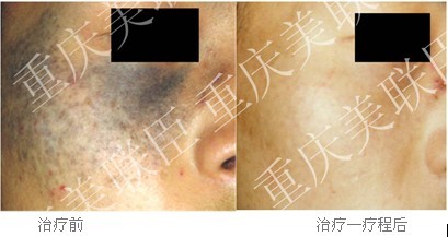 背部 激光治疗 痘痘