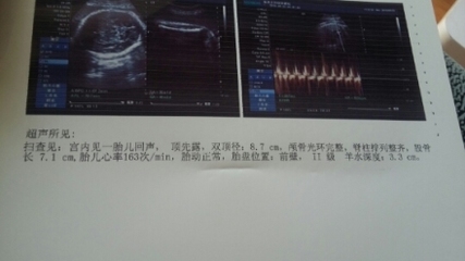 胎儿心跳过快是什么原因
