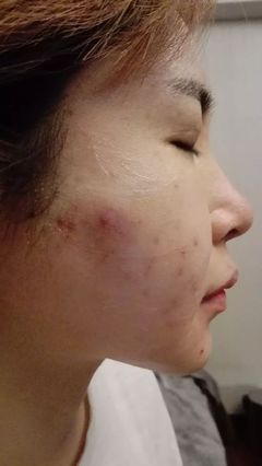 脸上的痘痘一直发炎怎么办