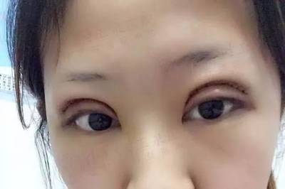 双眼皮切口处发红
