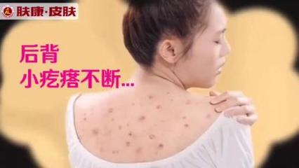 背部出痘痘怎么治疗方法