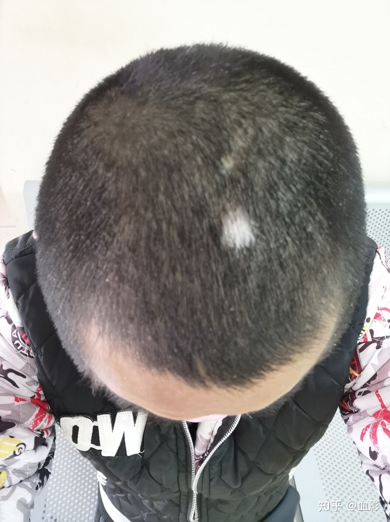 下巴经常长痘痘有白斑
