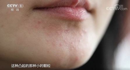 脸颊长闭口痘痘的原因分析