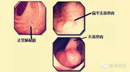 结肠息肉怎么治疗