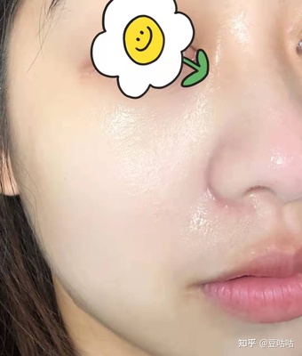 痘痘一个月了