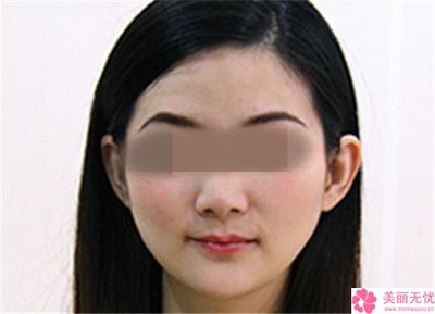 玻尿酸鼻唇沟多少钱